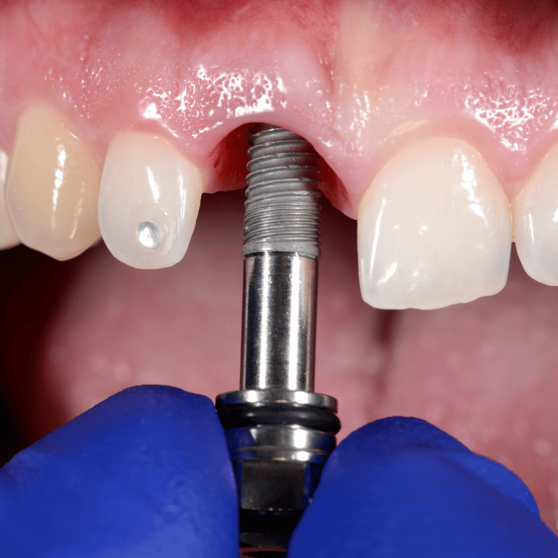 Dental Implants in Kandy Dental Implants in Kandy