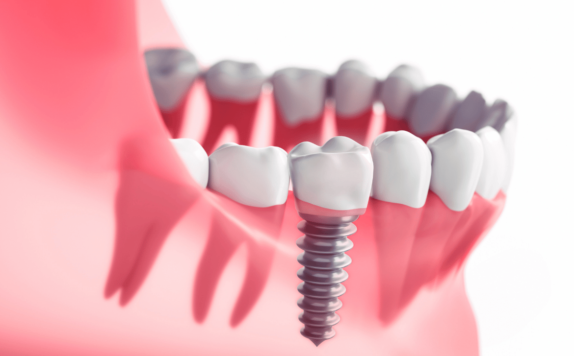 Same day Implants in Kandy