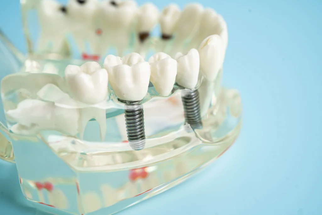 dental-implants