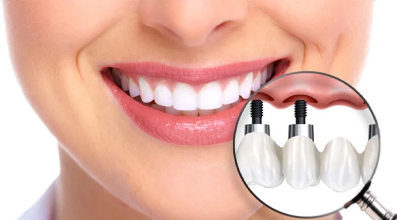 What Happens After Tooth Loss