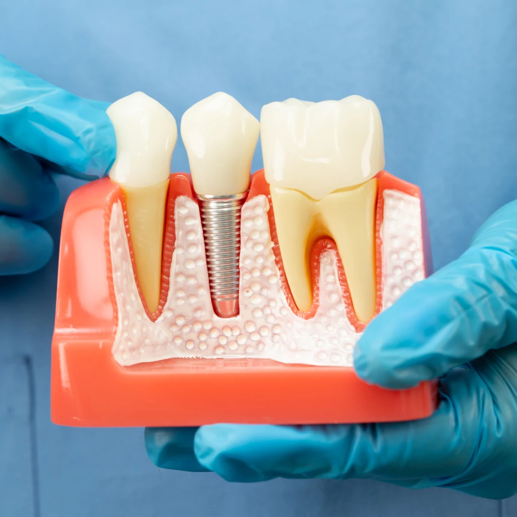 How Long Do Dental Implants Last